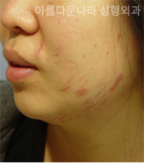 韩国吴金斯整形医院面部吸脂手术对比案例_术前