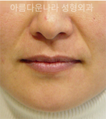 韩国吴金斯整形外科埋线提升手术日记