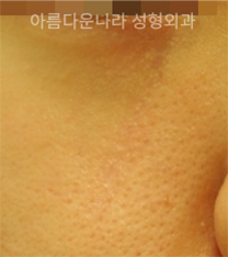 韩国吴金斯整形外科面部祛疤手术对比案例_术后