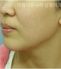 韩国吴金斯整形医院面部吸脂手术对比案例