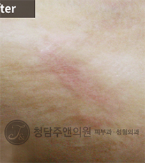 韩国清潭珠颜整形医院祛疤手术对比案例