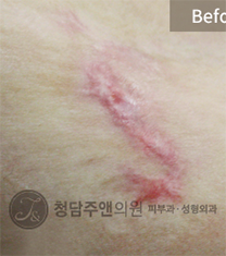 韩国清潭珠颜整形医院祛疤手术对比案例