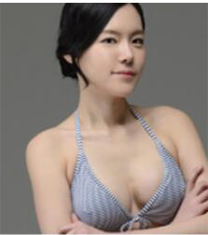 韩国奥纳比整形外科硅胶内窥镜隆胸案例