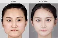 韩国原辰整形外科双颚+眼鼻+面部轮廓+面部提升，美若天仙