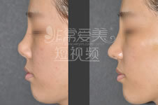 韩国will整形外科：与顾客隆鼻手术意见相左时该怎么办？