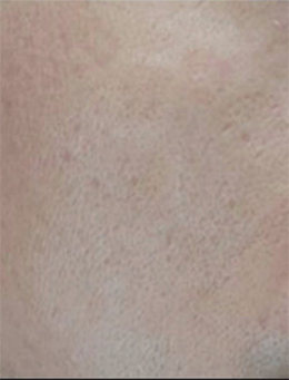 韩国lucea整形外科-韩国lucea整形医院面部祛疤手术对比案例
