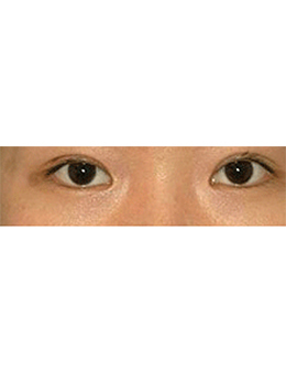 韩国lucea整形外科眼部手术对比案例_术后