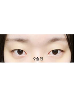韩国美丽的人双眼皮手术惊艳案例对比