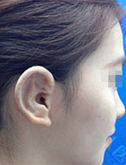 上海东方丽人整形医院小耳畸形矫正对比