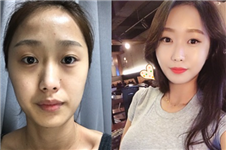 网友分享：在韩国ID做vline+颧骨缩小+脂肪填充的整形经历