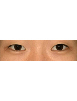 韩国lucea整形外科眼部手术对比案例_术前