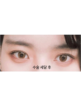 韩国美丽的人双眼皮手术惊艳日记对比
