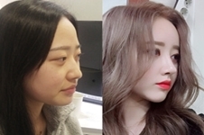 丽丝塔整形医院和韩国纯真相比谁更擅长自然风格鼻型？