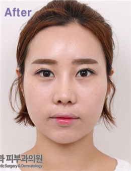 韩国BL医院全脸脂肪填充案例