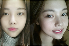韩国Faceplus整形眼部手术案例，风格特点大揭秘！