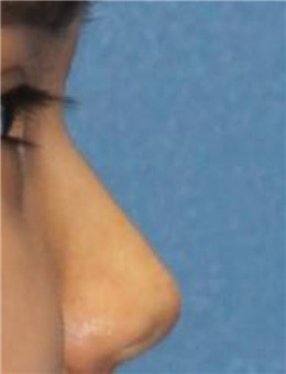 韩国fine整形外科隆鼻案例对比图