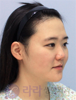 韩国lara整形外科隆鼻案例前后对比图_术前