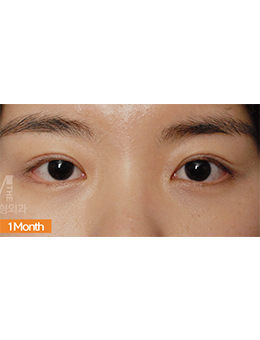韩国美佳（迪美）整形外科眼部手术案例