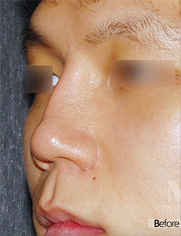 韩国迪美（美佳）整形外科男士隆鼻修复手术日记