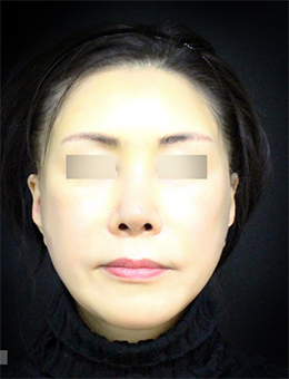 韩国迪美（美佳）整形外科面部脂肪填充手术案例