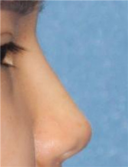 韩国fine整形外科隆鼻案例对比图