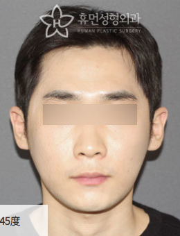 韩国秀梦整形外科男士颧骨整形手术对比案例_术后