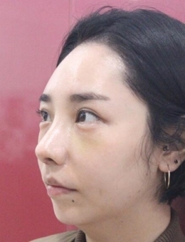 韩国清新整形外科鼻修复前后对比照片