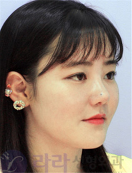 韩国lara整形外科隆鼻案例前后对比图_术后
