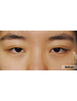 韩国美佳整形-韩国美佳（迪美）整形外科眼部手术日记