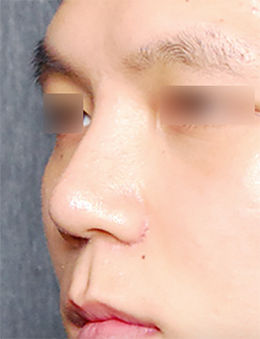 韩国迪美（美佳）整形外科男士隆鼻修复手术日记