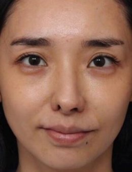 韩国清新整形外科鼻修复前后对比照片