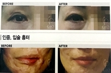 你的疤痕有救啦！韩国gio整形外科医院疤痕修复案例大曝光