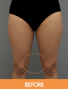 韩国劳波儿整形外科大腿吸脂手术案例