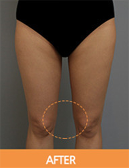 韩国劳波儿整形外科大腿吸脂手术日记
