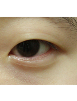 韩国righthand整形外科眼睑下垂矫正手术对比案例