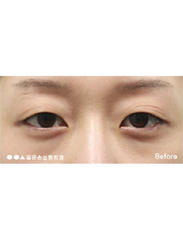 韩国righthand整形外科双眼皮手术对比案例