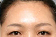 韩国人气整形卓佑炫外科，内窥镜修复抬头纹案例