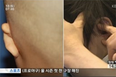 耳畸形造成大小脸怎么办？韩国矫正修复常用这些方案！