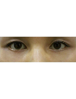 韩国righthand整形外科眼底脂肪重置手术案例