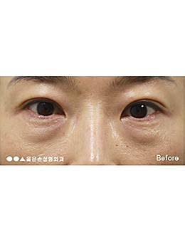 韩国righthand整形外科下眼睑矫正手术案例