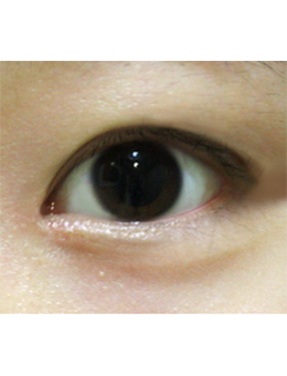 韩国righthand整形外科眼睑下垂矫正手术对比案例