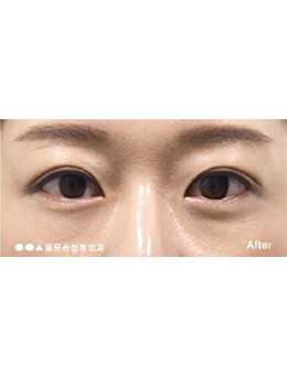 韩国righthand整形外科双眼皮手术对比案例