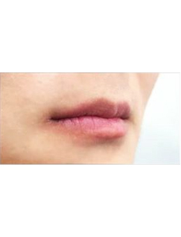 韩国boneeye整形外科-韩国themoon整形外科唇部手术对比案例