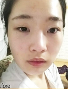 韩国themoon整形外科脂肪填充+眼综合手术对比案例_术前