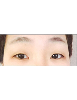 韩国boneeye整形外科-韩国themoon整形外科眼部手术案例