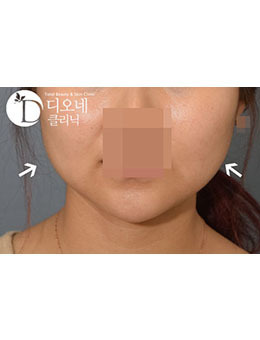 韩国Dione整形外科注射瘦脸瘦脸真人日记对比