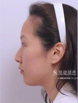 韩国propose整形外科驼峰鼻矫正手术日记