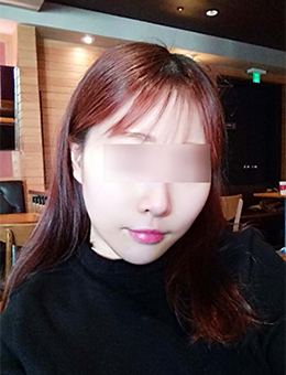 韩国NVU整形外科面部吸脂真人恢复案例