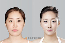 韩国博朗温整形金兑奎面部轮廓V脸+鼻修复手术日记
