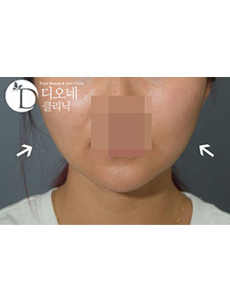 韩国Dione整形外科注射瘦脸瘦脸真人日记对比